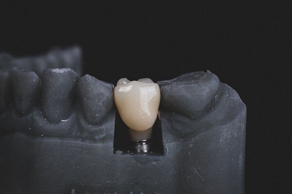 Everything You Need to Know About Dental Implants!