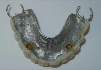 2 Locator Attachments for 2 dental implants