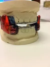 Respire Medical Appliance for Sleep Apnea and Snoring