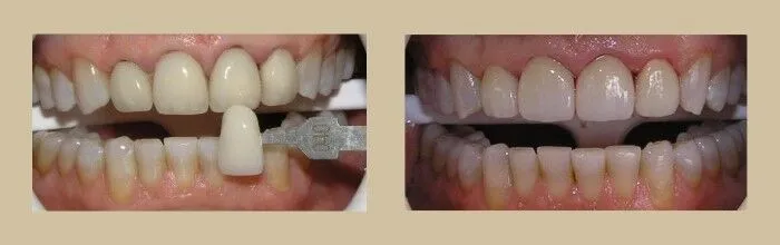 Porcelain Veneers