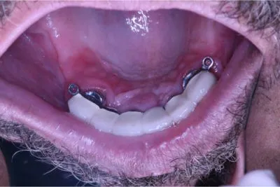 Acrylic teeth were used to stay within the patient’s budget. Acrylic teeth can be easily repaired and replaced with very little expense.