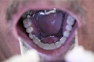 Metal occlusal design which will prevent the teeth from breaking off the frame and provide long term durability