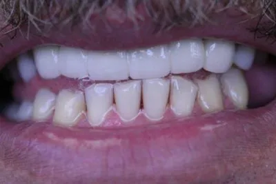 Metal occlusal design which will prevent the teeth from breaking off the frame and provide long term durability