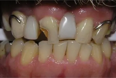 2 Locator Attachments for 2 dental implants
