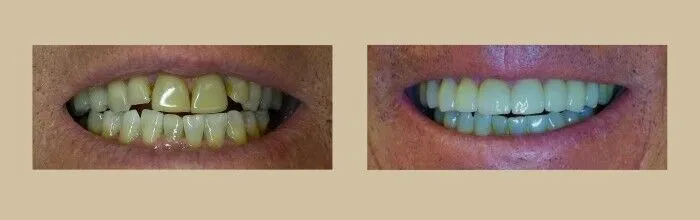 Porcelain Veneers