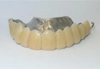 Acrylic teeth were used to stay within the patient’s budget. Acrylic teeth can be easily repaired and replaced with very little expense.