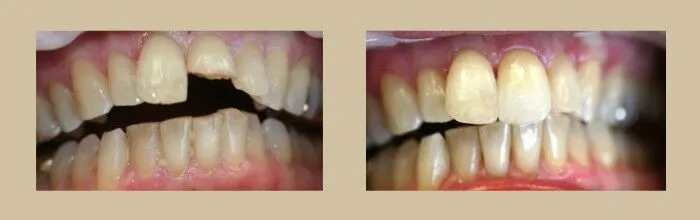 Porcelain Veneers