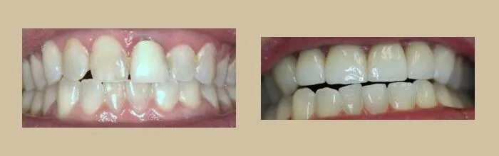 Porcelain Veneers