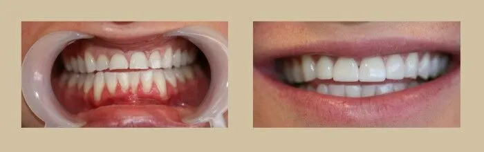 Porcelain Veneers