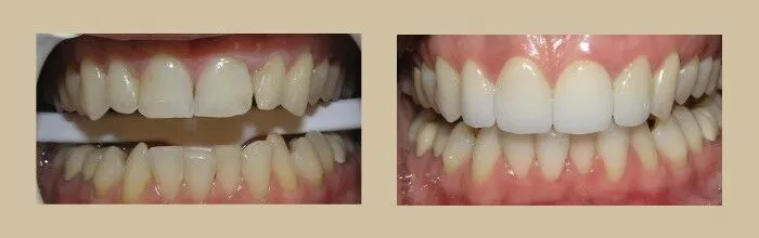 Porcelain Veneers