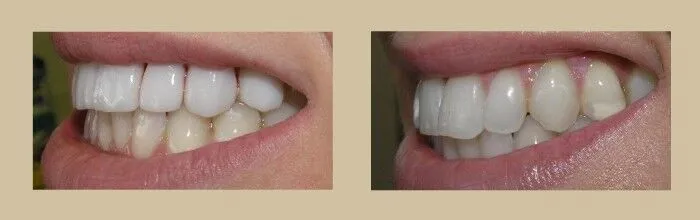 Porcelain Veneers