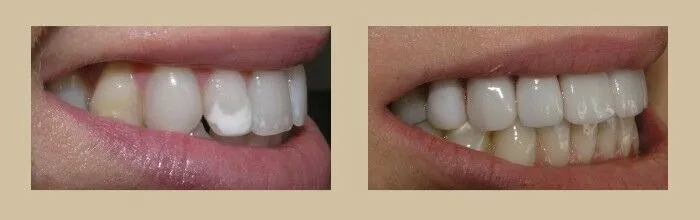 Porcelain Veneers