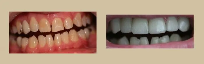 Porcelain Veneers