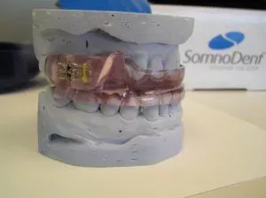 SomnoMed Appliance for Sleep Apnea and Snoring