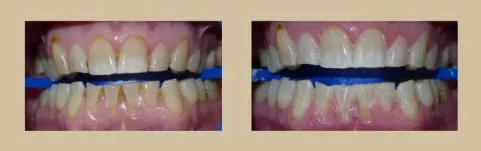 Teeth Whitening