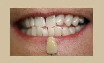 Teeth Whitening