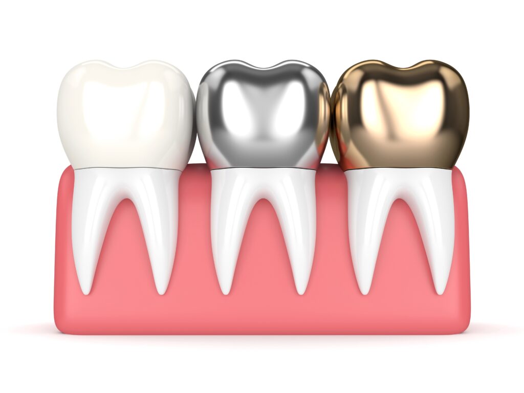 Rendering of different dental crown options