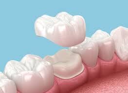 dental crowns in Scottsdale