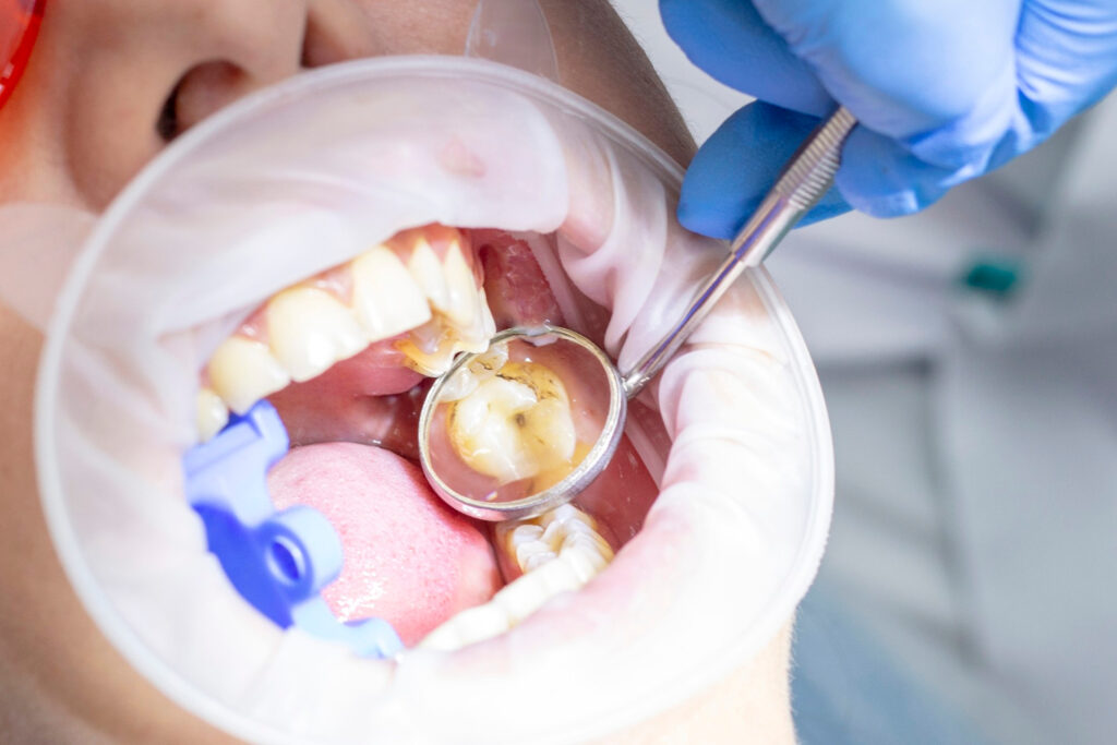 Family dentist near me offering sealants