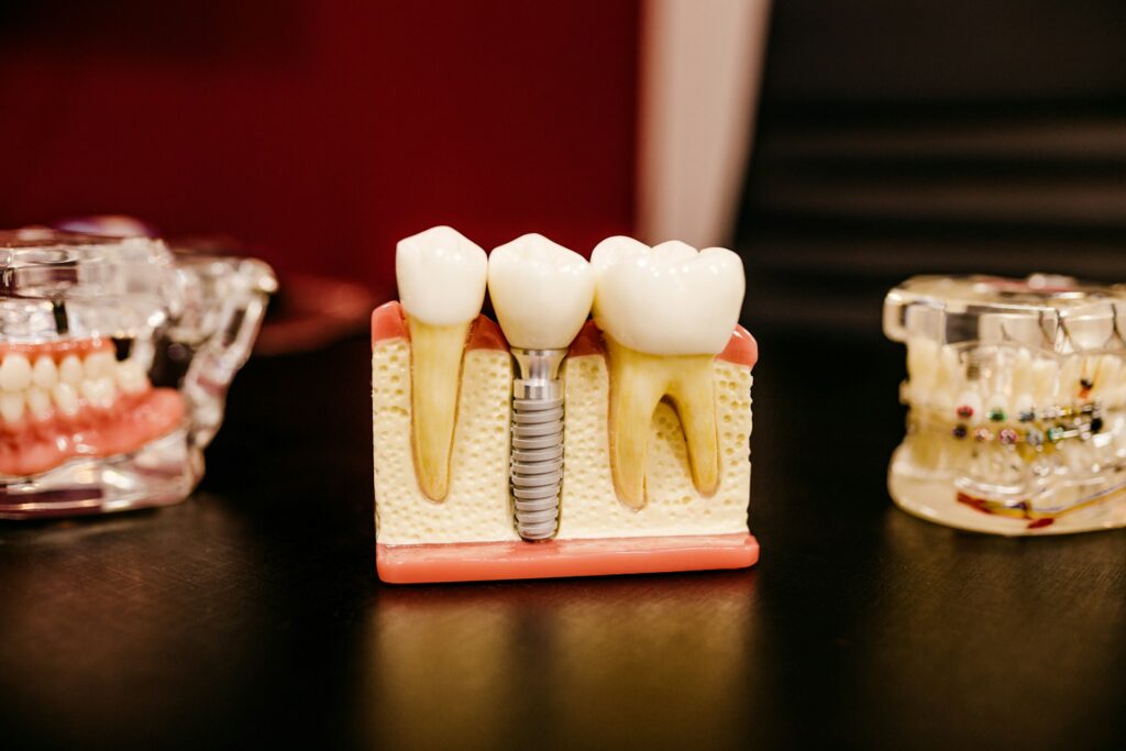 Dental implant treatment